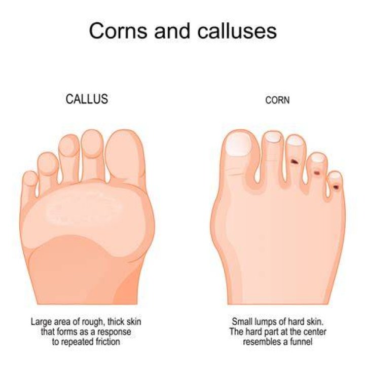 A callus is a thick, yellowish lump of dead skin