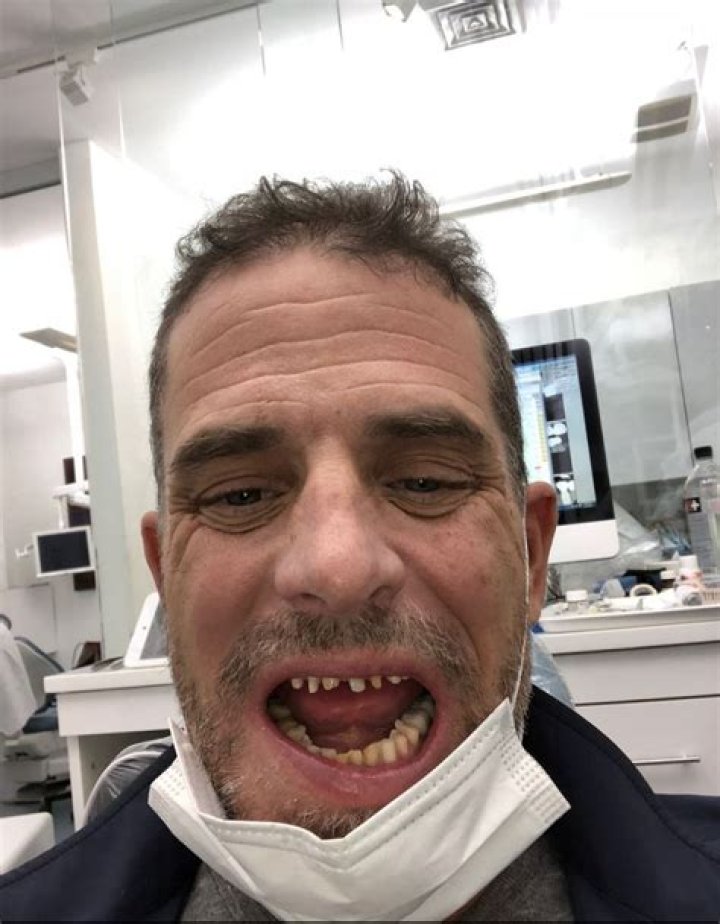 A snap showing Hunter Biden with ruined teeth