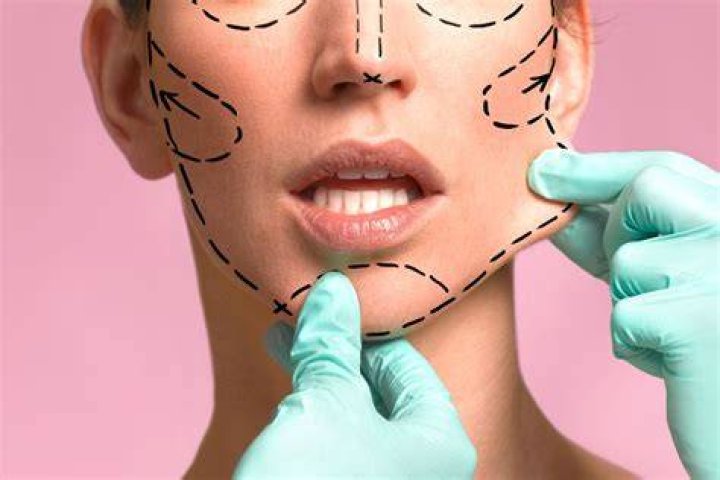 According to a plastic surgeon, Kim may also have undergone liposuction and a fat transfer to her butt, while fans have wondered whether she purposefully dresses to hide BBL scars