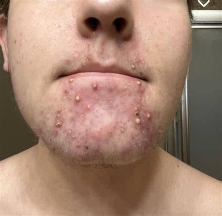 Acne has gotten worse in the pandemic due to mask-wearing