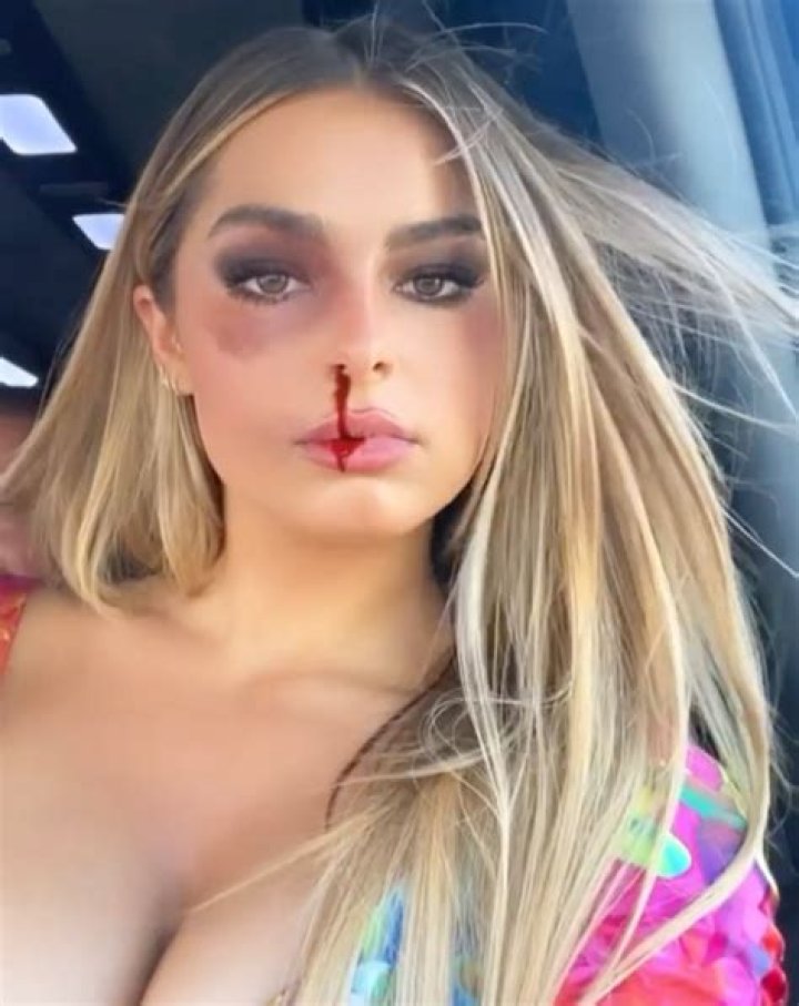 Addison Rae worried her fans with a new post of herself with a black eye and bloody nose