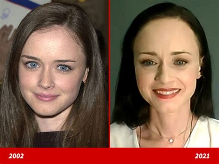 Alexis after her first face transplant