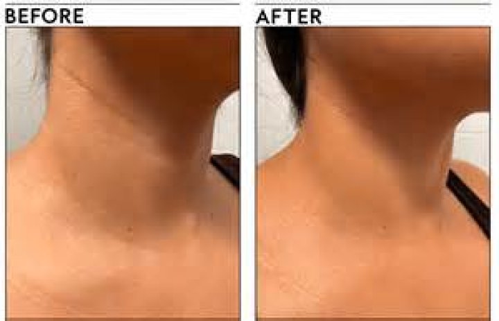 before-and-after-neck cream
