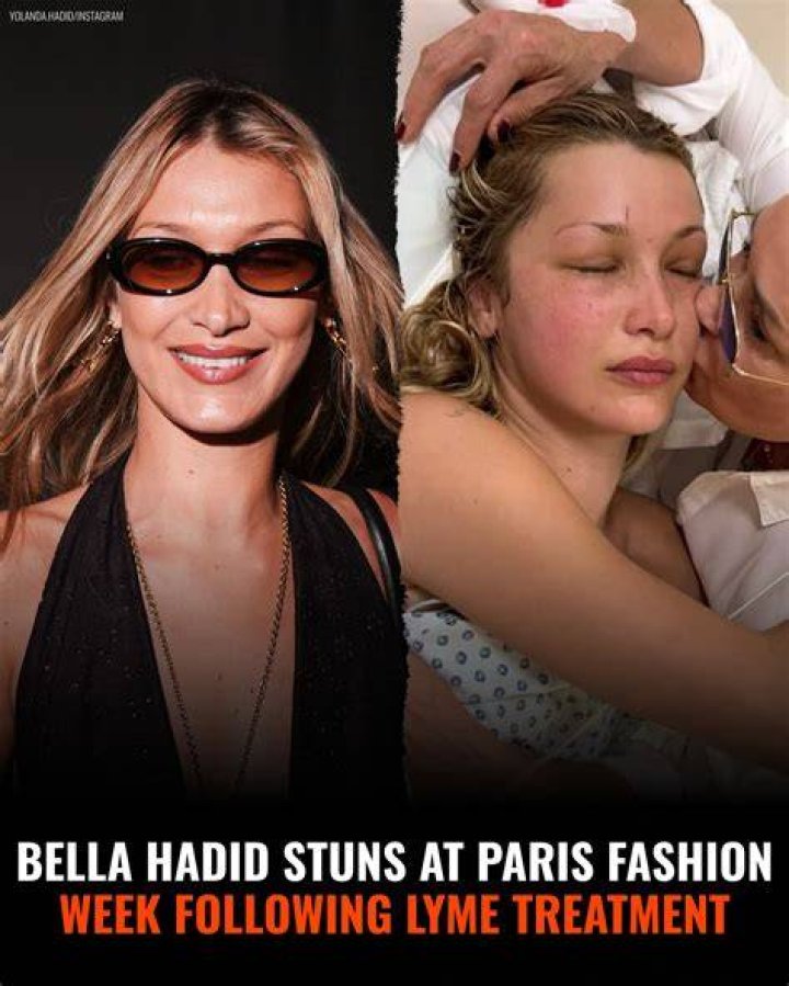 Bella Hadid opened up about plastic surgery