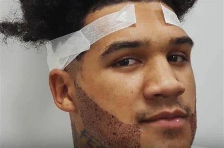 Benn, 23, underwent beard transplant surgery in November