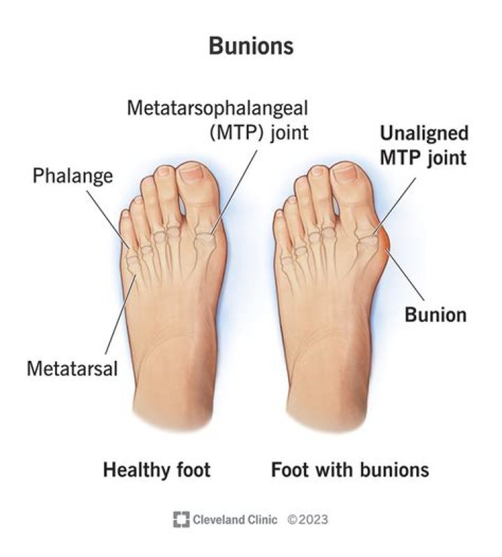 Bunions are hard, bony lumps on the side of your foot by your big toes