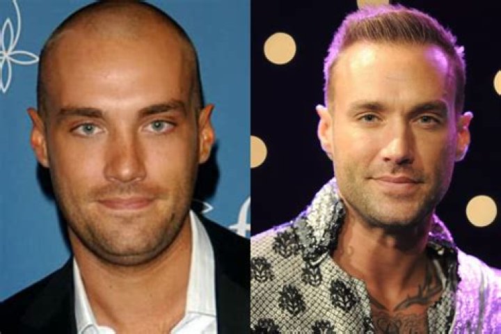  Celebrities including Calum Best have opted for the surgery to cover their bald spots