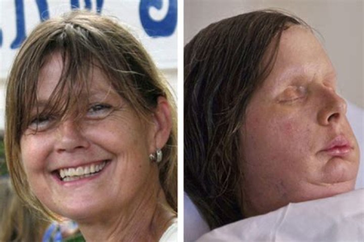Charla Nash revealed the horrific extent of her injuries on Oprah