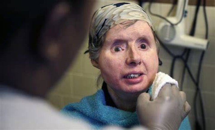 Charla Nash was savagely mauled by her friend's pet chimpanzee