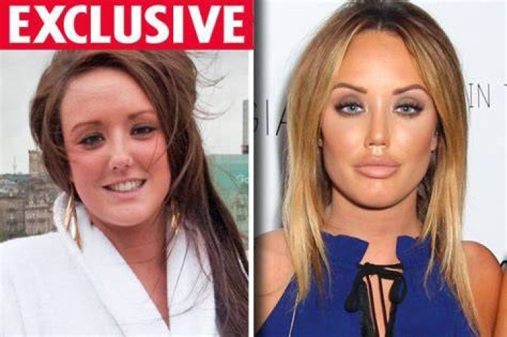 Charlotte Crosby pictured pre-surgery in 2014
