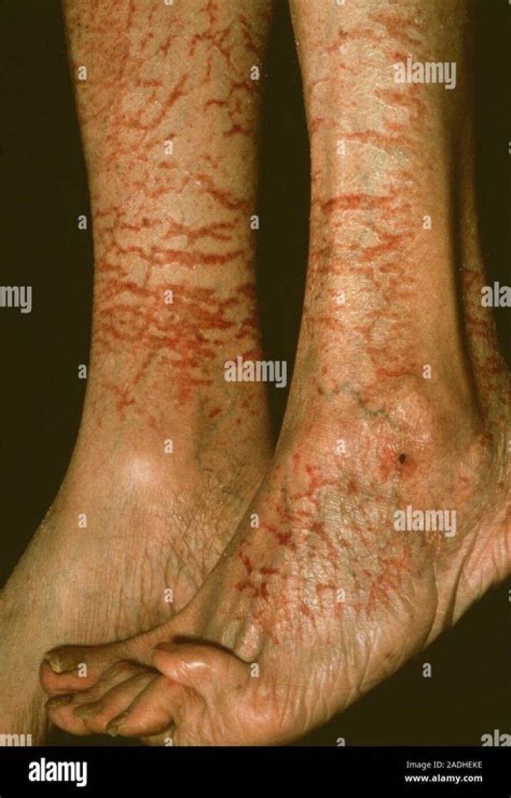Cracked skin is usually due to a lack of moisture