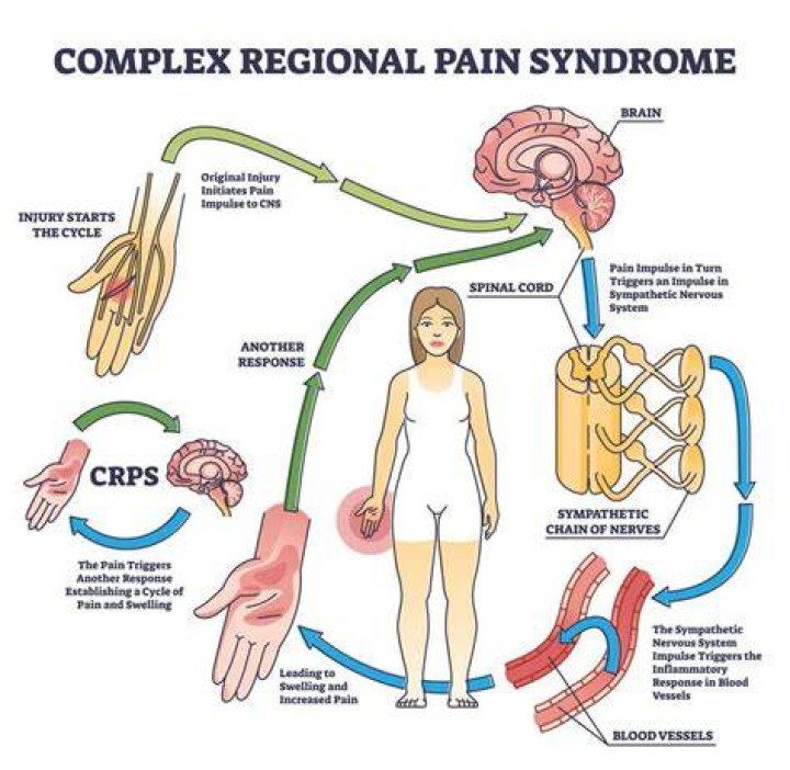 CRPS has also caused her to have reactions on her skin, with the pain radiating across her whole body