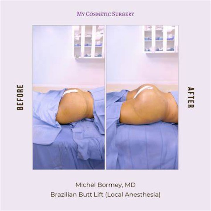Her bum after the surgery