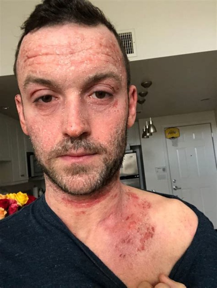  His eczema was getting progressively worse and despite increasing the quantity of cream he applied, his skin was uncontrollable