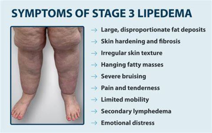 In addition to having lipoedema, Kahlida has lost 200lbs in weight, so has some loose skin