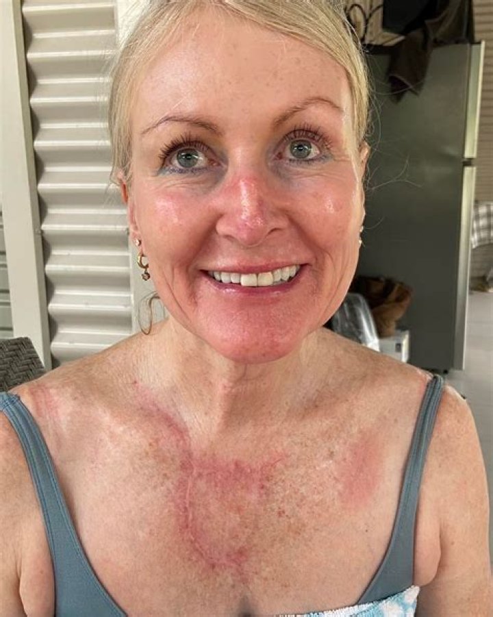 Jillian pictured while healing since her surgery