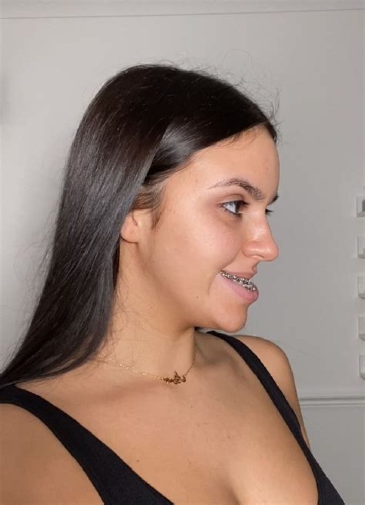 Jordan Davies spent six years &lsquo;hiding&rsquo; her prominent chin after bullies branded her &lsquo;shovel face&rsquo;