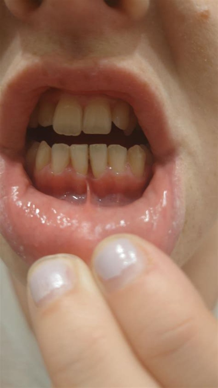 June lost a tooth last year while eating cakes