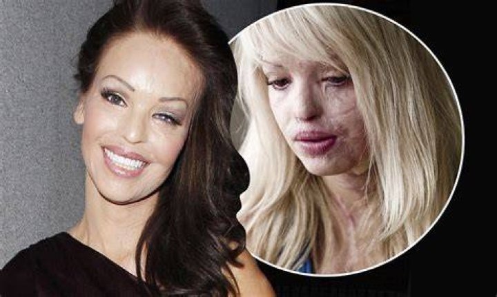  Katie Piper was the victim of a acid attack in 2008