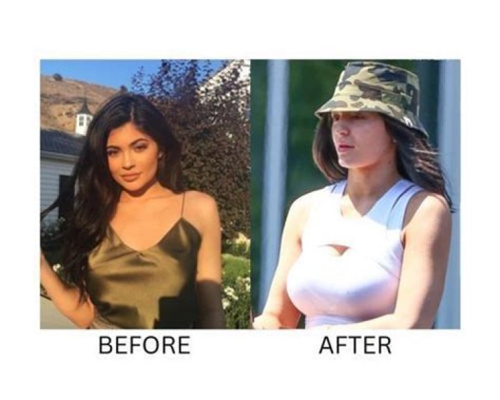 Kylie has sparked breast augmentation rumors in the past 