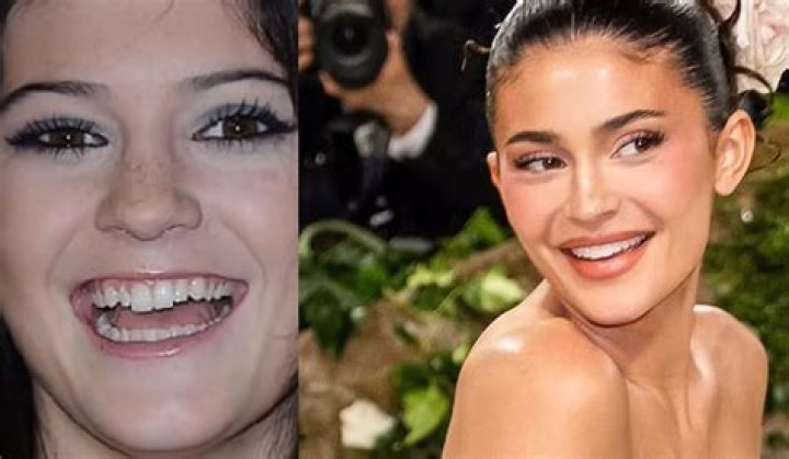 Kylie Jenner showed her teeth in a rare smiley video in Paris as fans fear she can't close her mouth due to lip filler