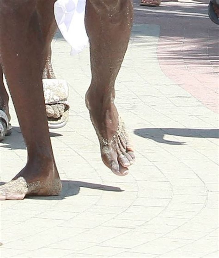 LeBron walks barefoot in Miami where the toe on his left foot overlaps his big toe and where a podiatrist says his skin requires regular scalpel treatment