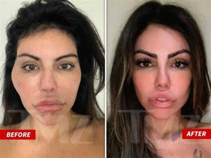 Liziane Gutierrez got the botched procedure done in Brazil