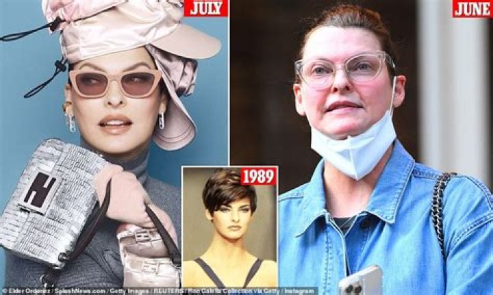 Model Linda Evangelista claimed that the procedure left her "deformed" and "permanently disfigured"