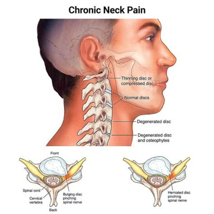 Neck pain can be caused by spinal misalignment or low flexibility in other parts of your body