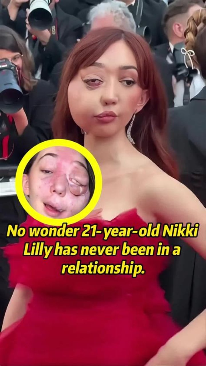 Nikki Lilly was diagnosed with a rare condition when she was six - and through social media she has done so much to raise awareness about it