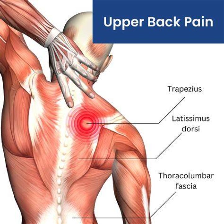 Pain in the upper back can be caused by pinched nerves, experts say