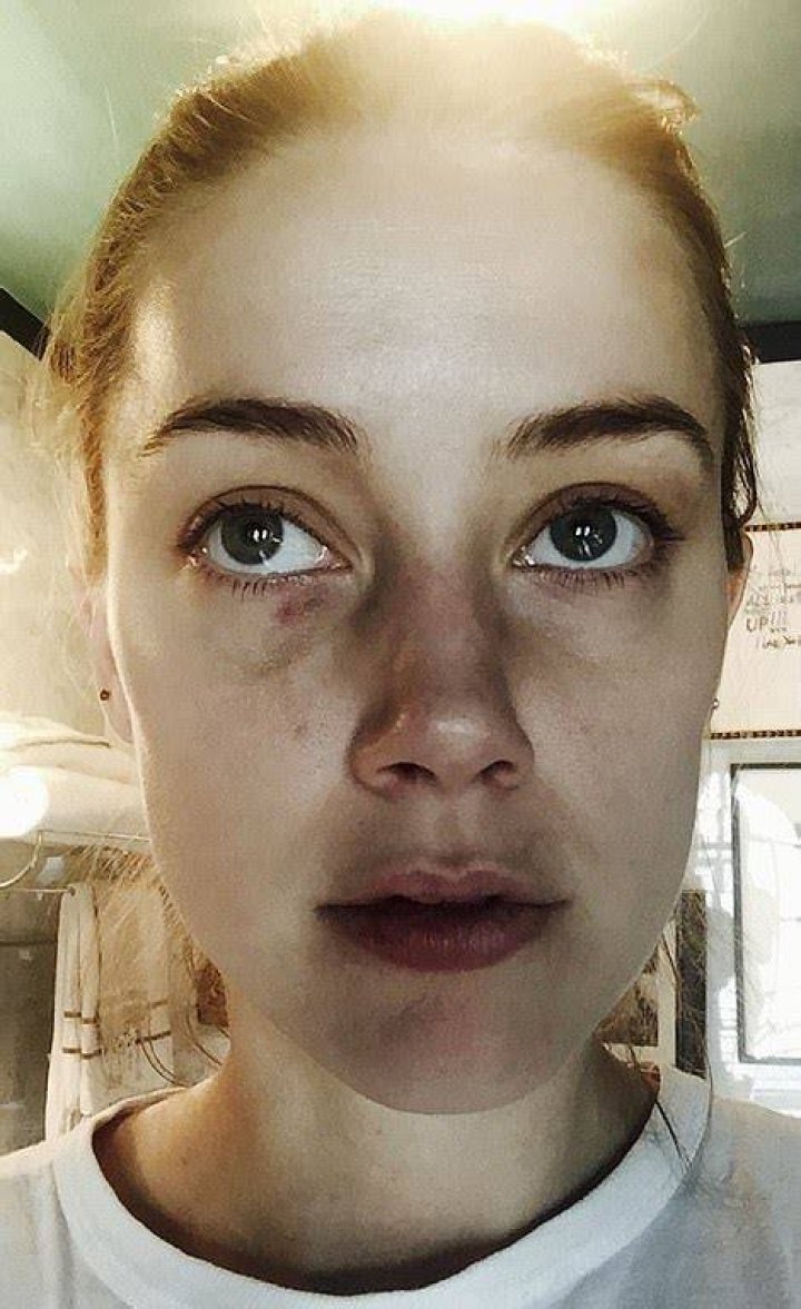 Photographs of Heard allegedly show the actress with bruises and a cut lip