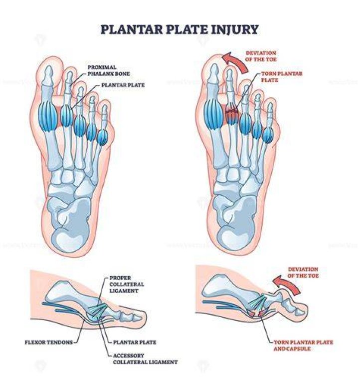 She had a torn plantar plate and ligament that had been getting worse over time.