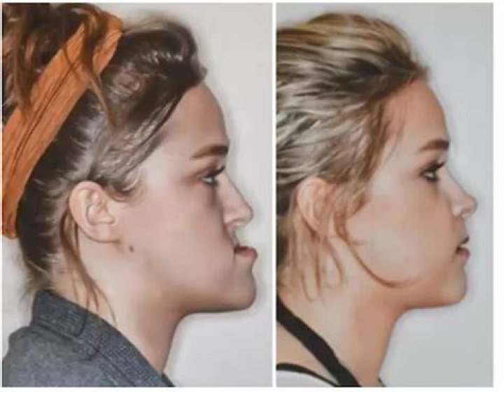 She had an extreme underbite and was told the condition would only get worse - so she decided to have surgery