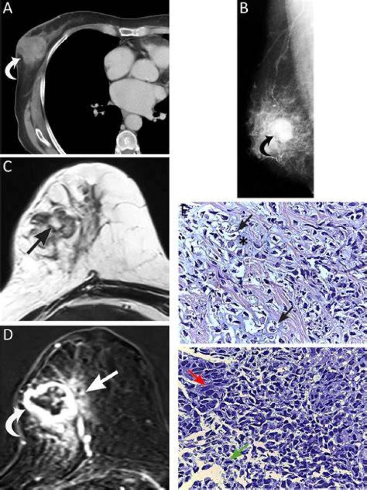 She was diagnosed with mesenchymal chondrosarcoma &ndash; a type of cancer &ndash; in April 2018