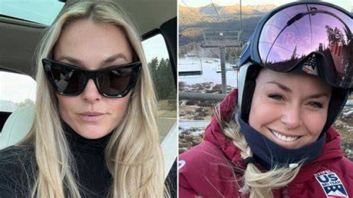 Ski legend Vonn shows off her teeth being ground down to make room for the veneers