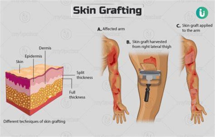  Skin grafts are taken from the back of the head where there's typically plenty of hair and re-inserted into the sparse areas