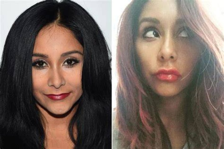 Snooki admitted to getting lip fillers