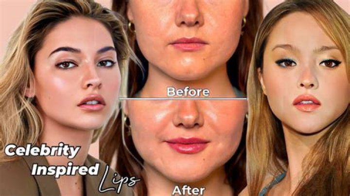 The model sparked lip filler rumors at the Super Bowl earlier this year
