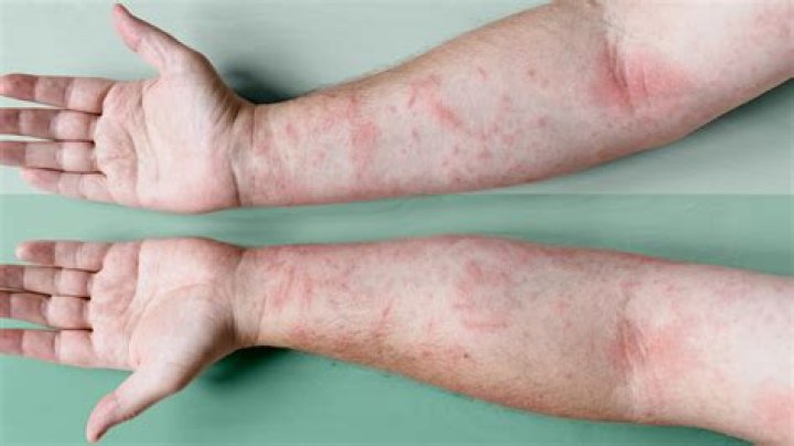 The shoppers spotted the eczema cream at Home Bargains for just a few quid