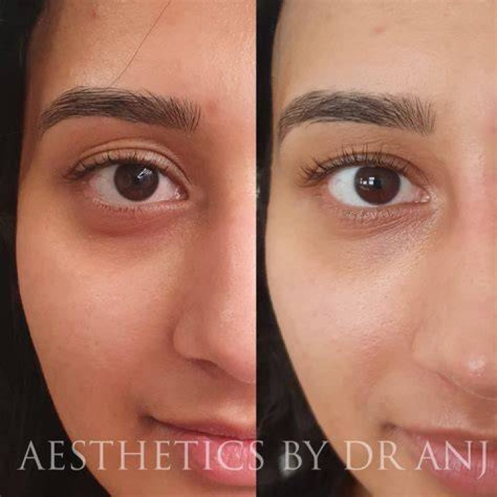 Under eye mesotherapy left me with red bruises that took two weeks to fade and is not worth it