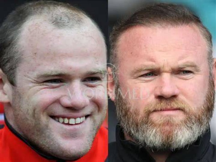  Wayne Rooney started going bald at 25
